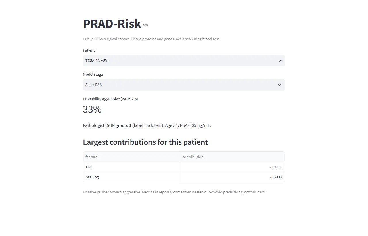 Patientenkarte TCGA-2A-A8VL: Stufe Alter und PSA, Wahrscheinlichkeit 33 Prozent